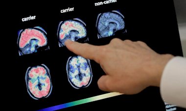 ABD'de 'beyin yiyen amip vakası görüldü'