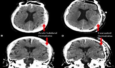 Ölüm anında insan beyninde neler oluyor? İlk kez görüntülendi