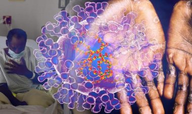 Latin Amerika ve Avrupa'da maymun çiçeğine bağlı ilk ölümler duyuruldu