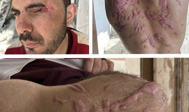 Gazze’den Sde Teiman’a: Bir mühendisin gözünü alan, bedenini yakan kimyasal işkence