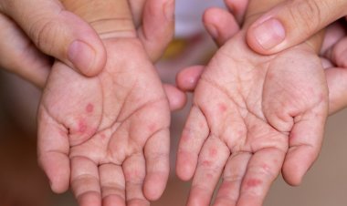 Endonezya'da kızamık salgını: 17 ölü