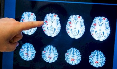 Beyninin yarısının olmadığını 60 yıl sonra öğrendi